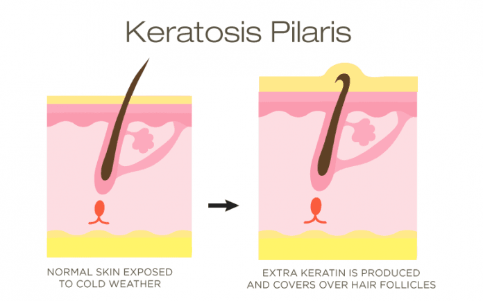 Keratosis Pilaris symptoms causes
