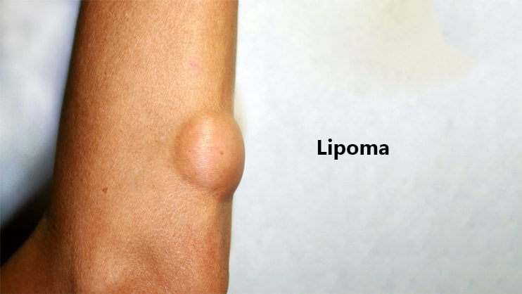 Lipoma – Symptoms, Causes, Risk factors & Types