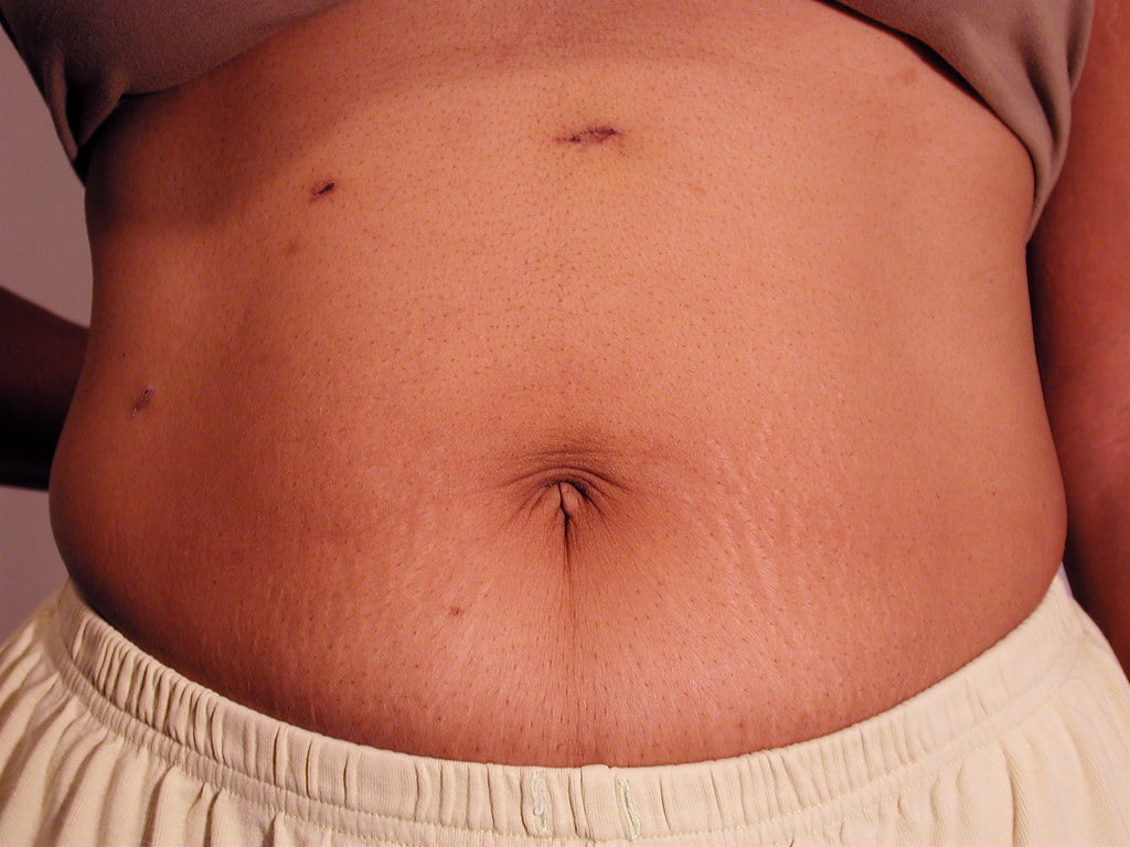 Cholecystectomy - Requirement & risks Cholecystectomy