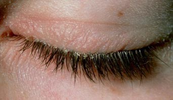 Blepharitis natural treatments - coconut oil and castor oil blepharitis