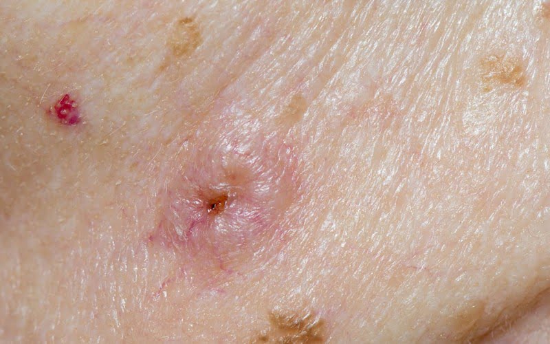 MRSA - Symptoms, Causes, Risk Factors And Complications