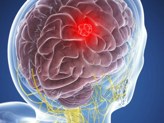 Meningioma