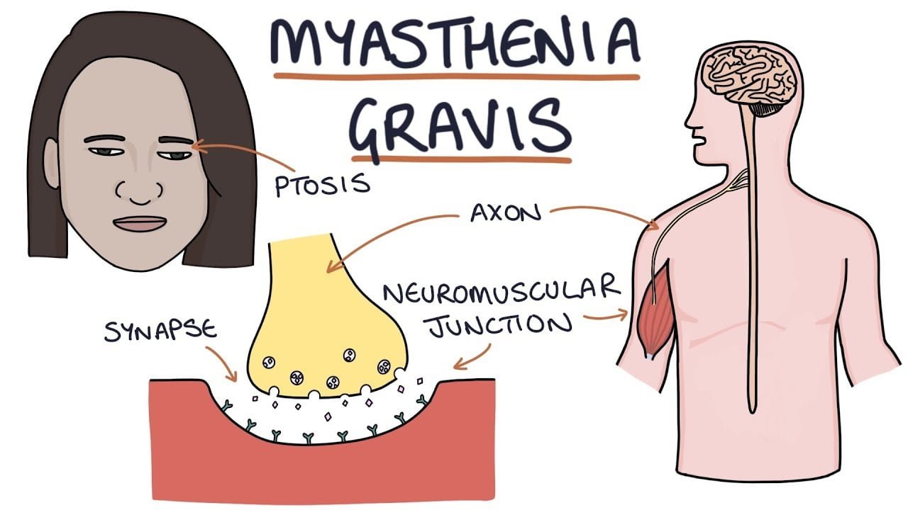 myasthenia-gravis-03-symptoms-causes-complications