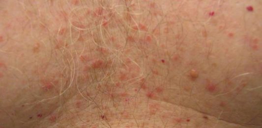 Natural cures for Grover's disease