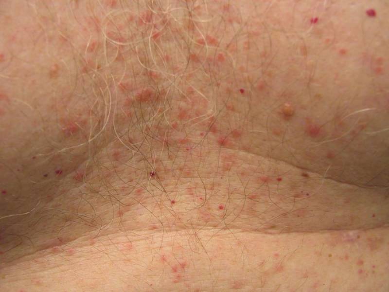Grovers Disease Pictures PictureMeta