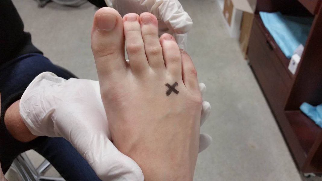 Morton’s neuroma treatment through home remedies