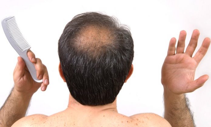 Natural cures for alopecia in men
