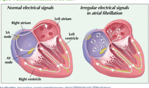 Atrial fibrillation treatment through home remedies