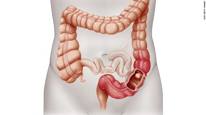Natural cures for colon cancer
