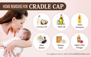 Effective natural treatments and home remedies for cradle cap