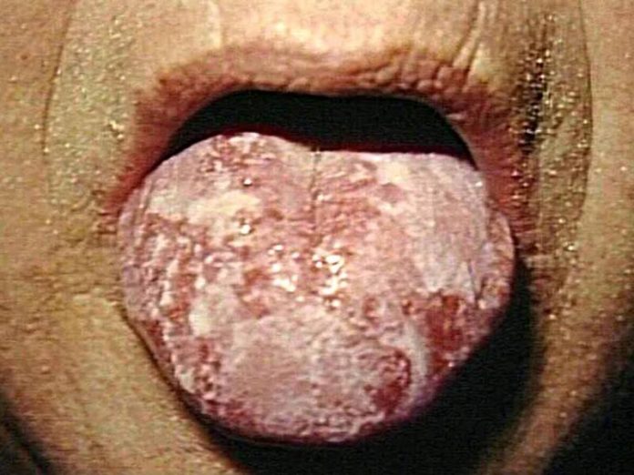 Natural cures for gonorrhea