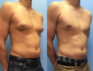 Dandelion and Omega 3 fatty acids are natural treatment for gynecomastia Natural cures for gynecomastia
