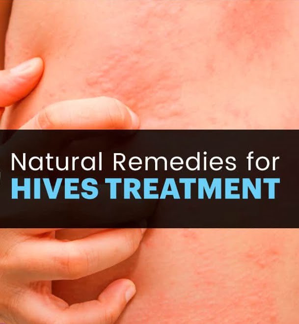 Natural cures for hives