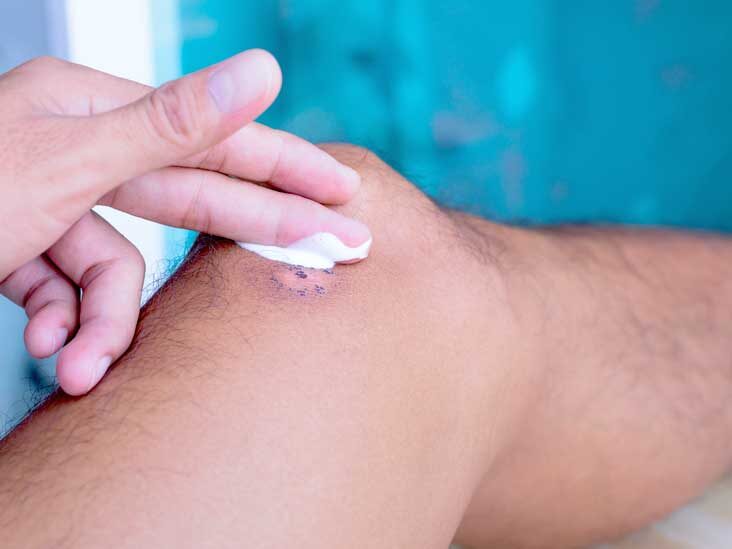 Natural cures for keloids