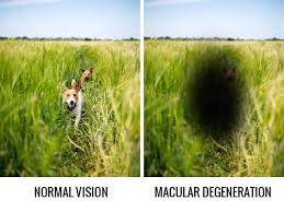Natural cures for macular degeneration