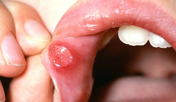 Natural cures for mouth ulcers