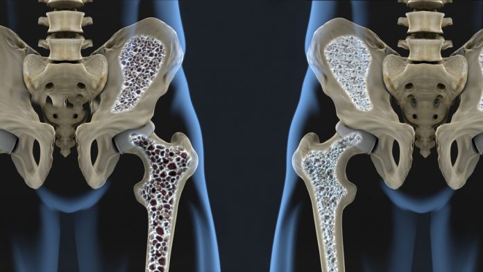 Natural cures for osteopenia