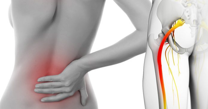 Natural cures for sciatica
