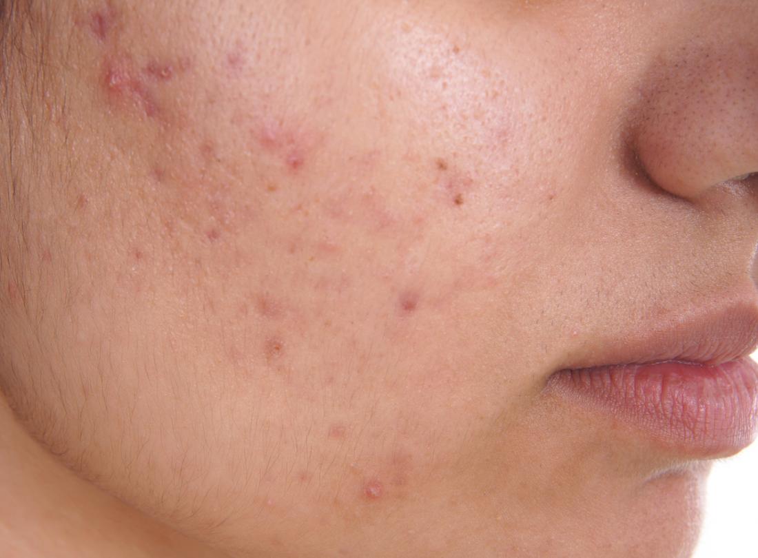 Natural cures for skin acne
