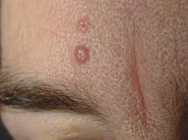 Natural cures for skin lesions