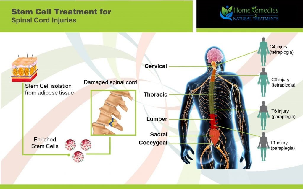 Natural cures for spinal cord injury