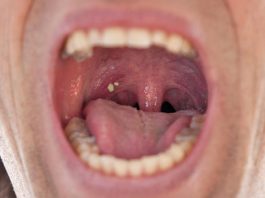 Natural cures for tonsil stones