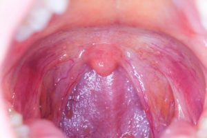 Natural cures for tonsillitis