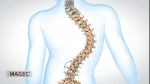 Natural treatments for scoliosis