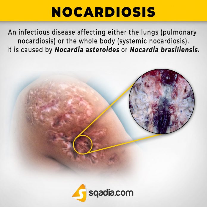 Nocardiosis