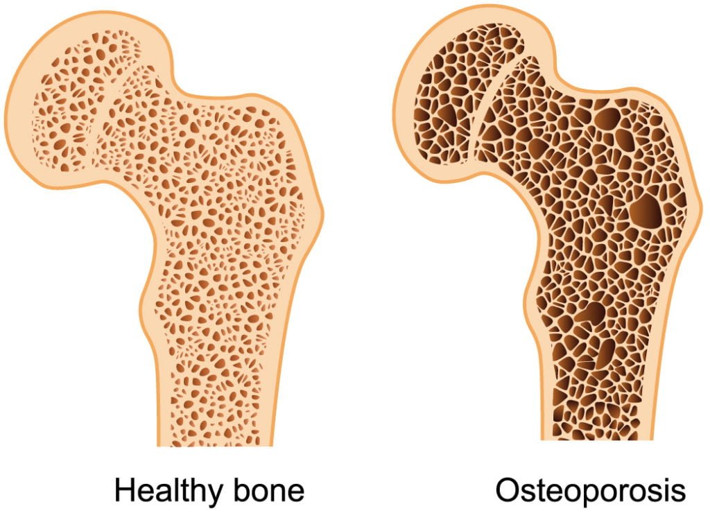 Bone Density Causes And Other Risk Factors Related