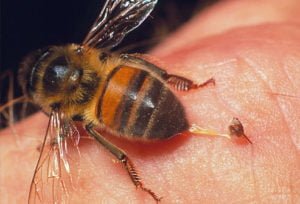 bee sting home remedy