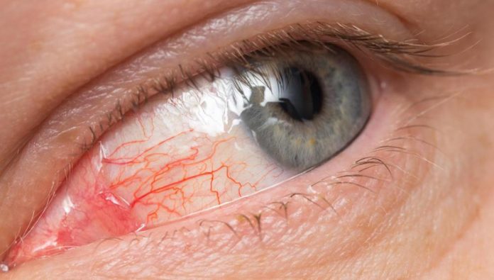 Pink eye Symptoms and Causes