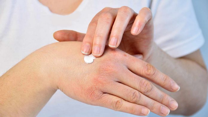 Psoriasis