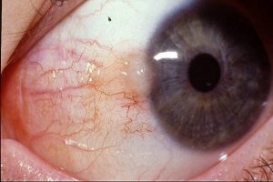  Pterygium Symptoms and Causes