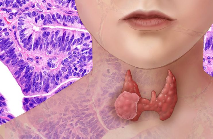 Radiation Poisoning Symptoms Causes And Complications