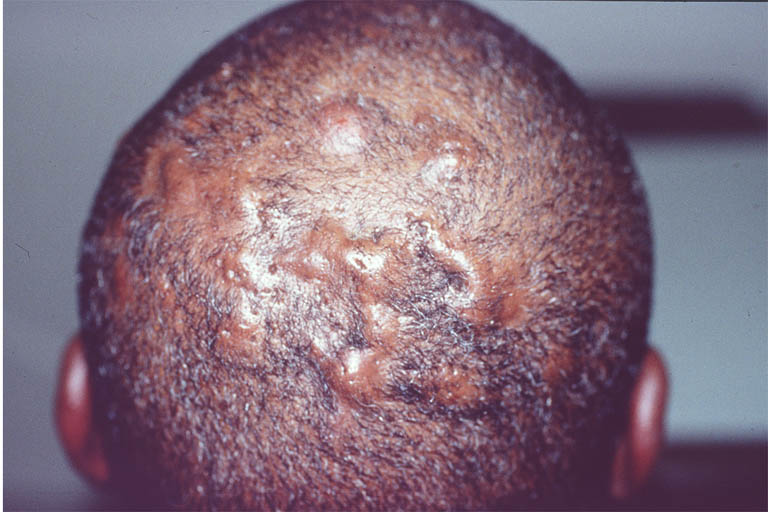 Scalp infection Home Remedy