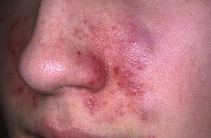 Seborrheic dermatitis Symptoms and Causes
