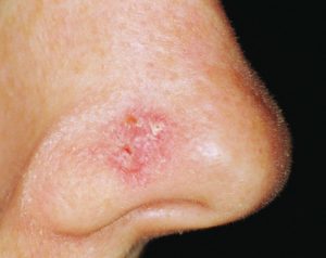 Skin cancer Symptoms and Causes