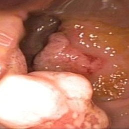 Solitary Rectal Ulcer Syndrome