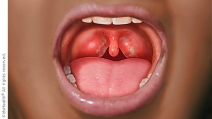 Natural cures for strep throat