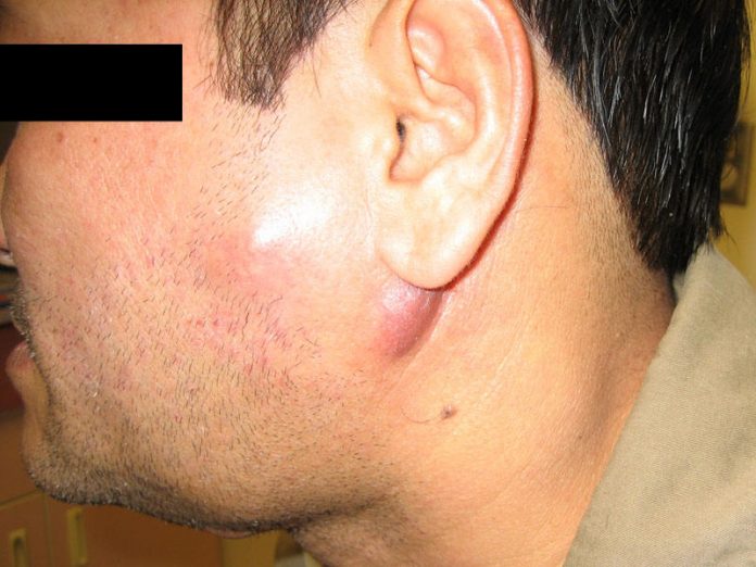 lymph nodes in face