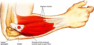 Tennis elbow - symptoms, causes and other associated risk factors Tennis elbow - symptoms, causes and other associated risk factors