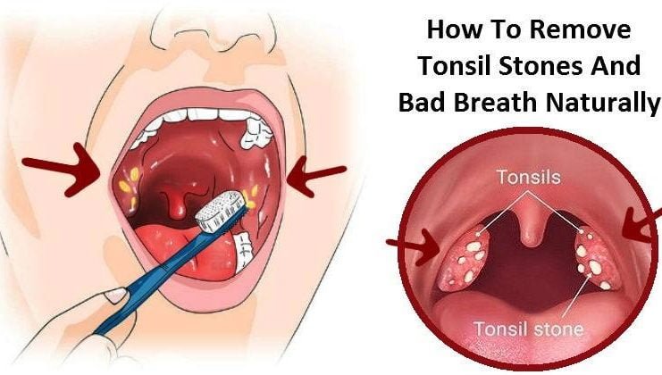 Tonsil Stones