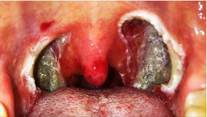 Tonsil stones Symptoms and Causes Tonsil stones Symptoms and Causes
