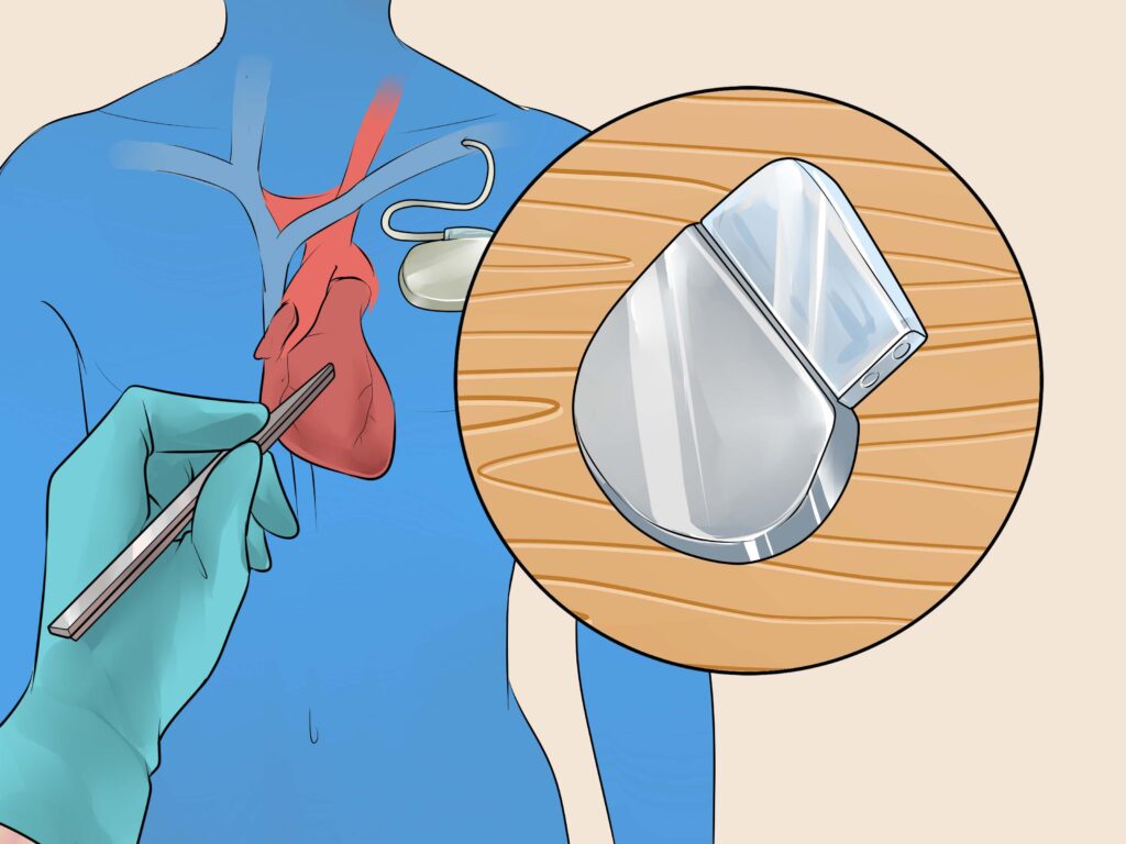 Best 17 Natural Treatments For Tachycardia