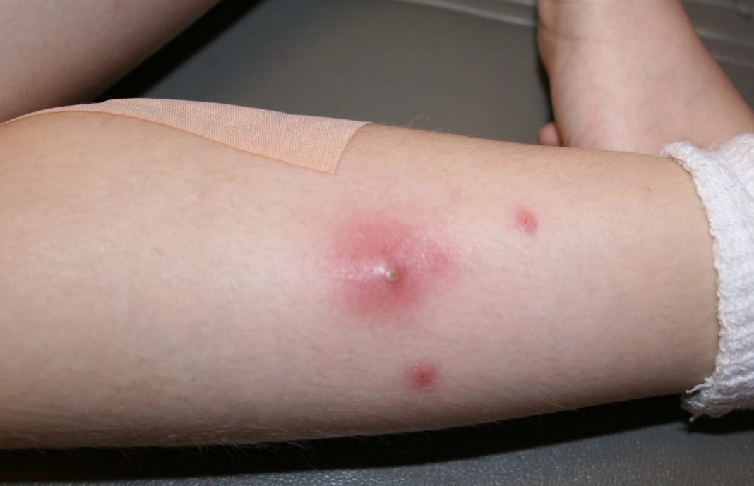 Staph infection symptom and causes Staph infection symptom and causes