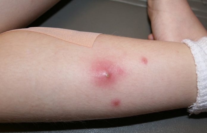 Staph infection symptom and causes