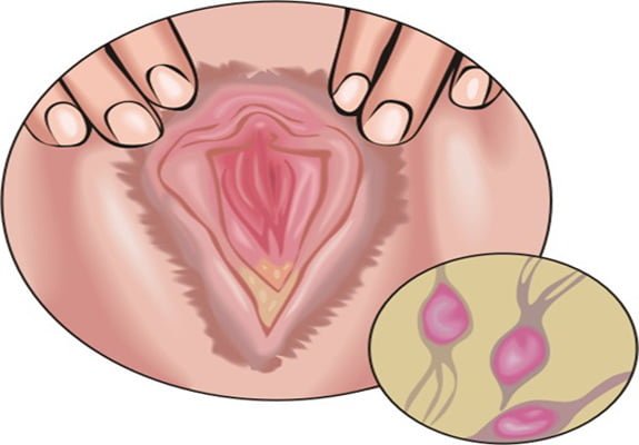 Trichomoniasis Symptoms, Risk factors and Complications