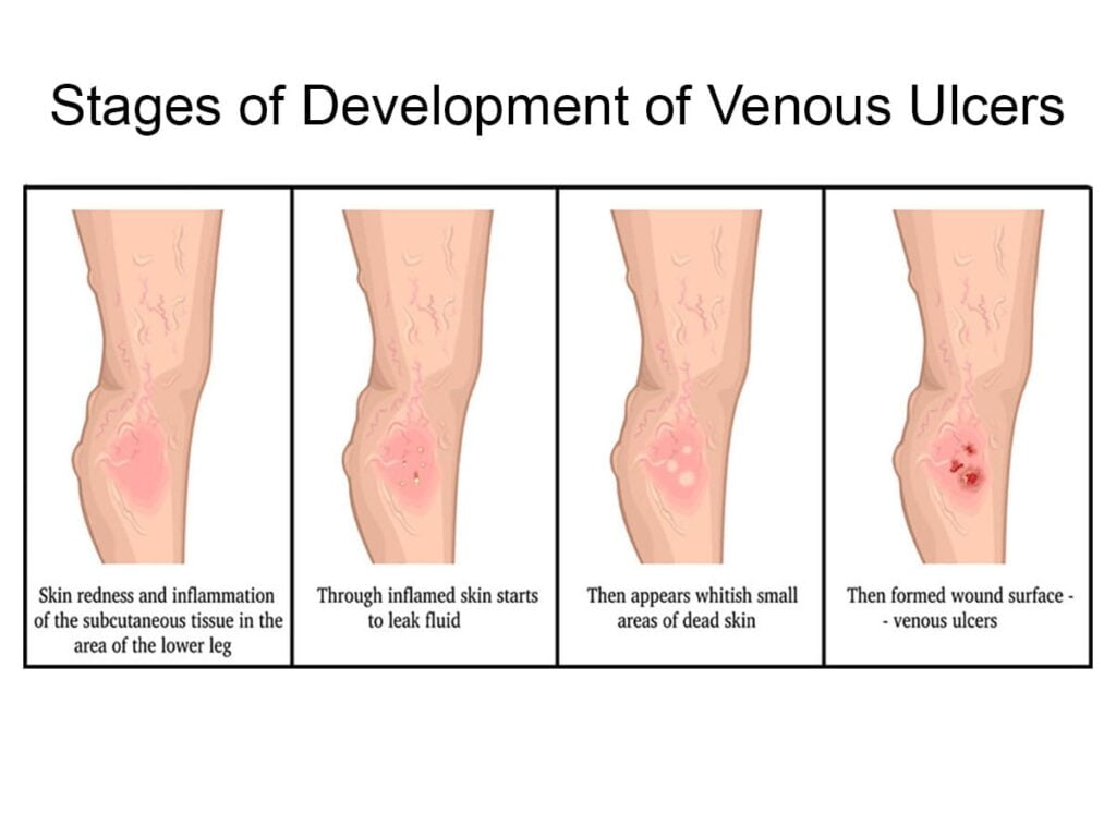 Leg Ulcers: Causes & 7 Symptoms Leg Ulcers