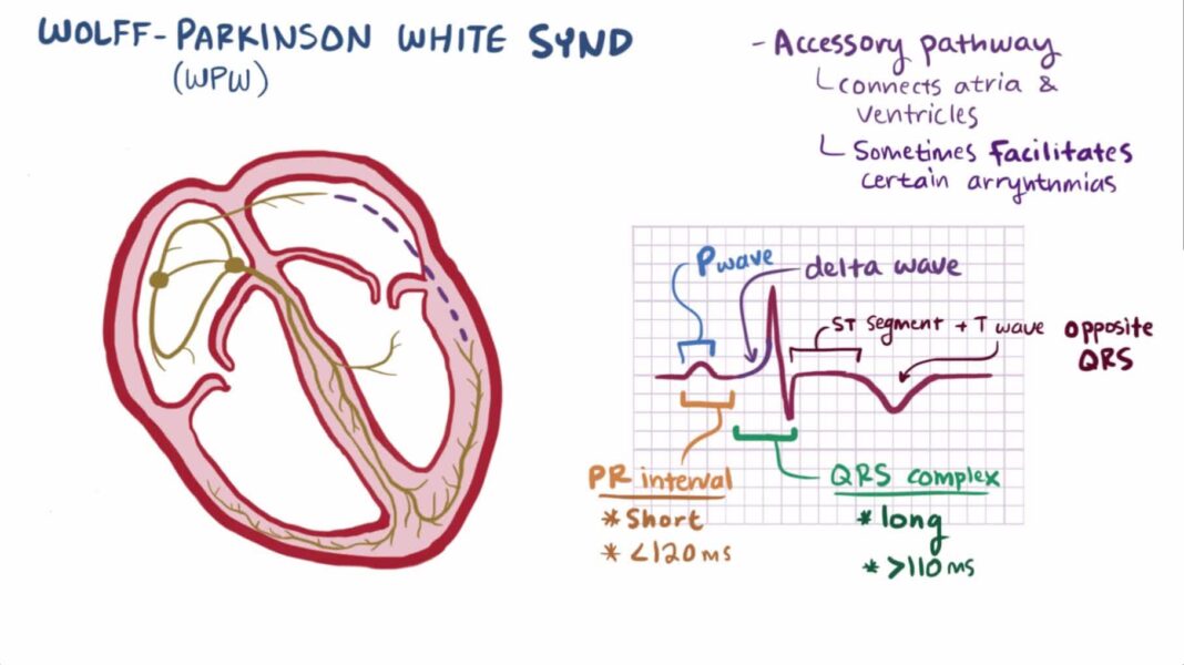 Wolff-Parkinson-White syndrome – Causes & Complications